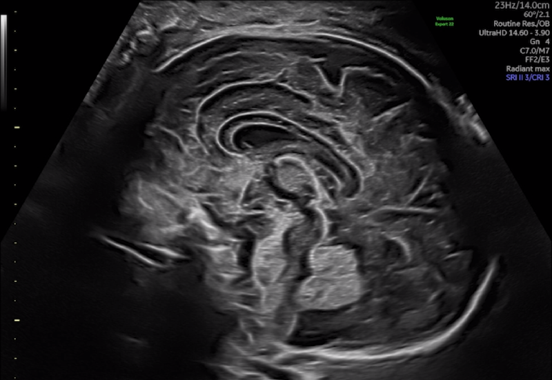 Featured image of post Εμβρυικό νευροϋπερηχογράφημα